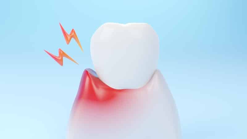 Schmerzempfindliche Zähne – das sind mögliche Ursachen - Zahnarzt Gießen Dr. Röder
