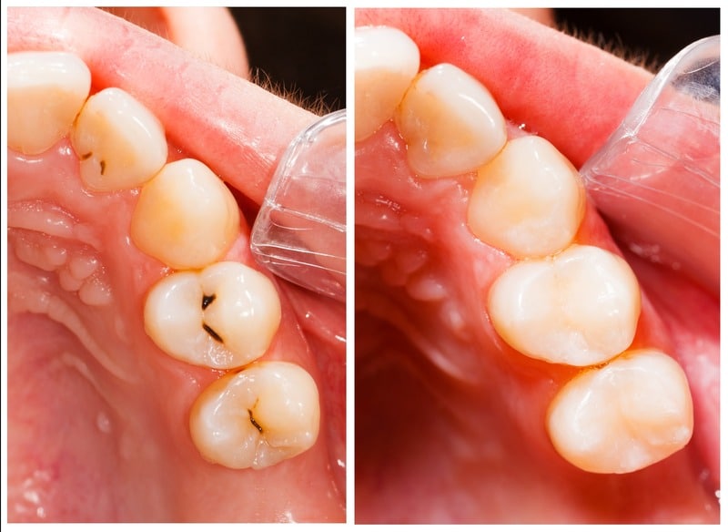 Was ist eine Kompositfüllung und was sind die Vorteile von Kunststofffüllungen - Zahnarzt Gießen